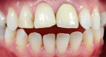 Teeth Whitening & Emax Crowns/Veneers before
