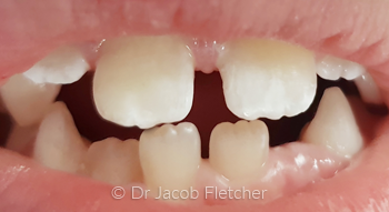 Composite Bonding (Child) After