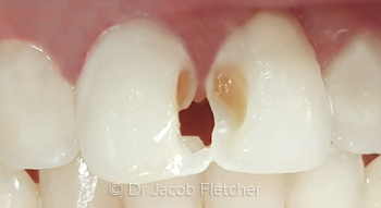 Composite Fillings Before