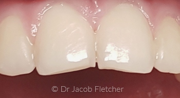 Composite Bonding Before