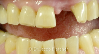 Partial Denture Before