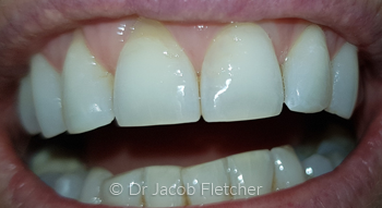 Enameloplasty After