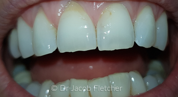 Enameloplasty Before