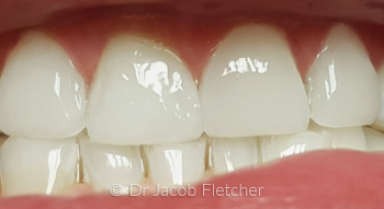 Teeth Whitening & Composite Bonding After