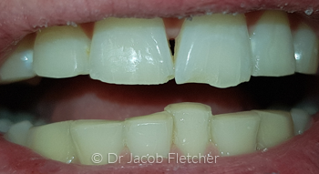 Enameloplasty Before