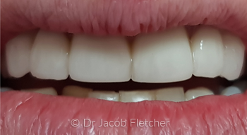 Teeth Whitening & Emax Bridge & Veneers After