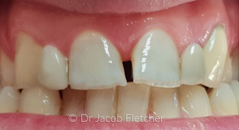 Teeth Whitening & Emax Bridge & Veneers before