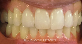 Teeth Whitening & Emax Crowns/Veneers After