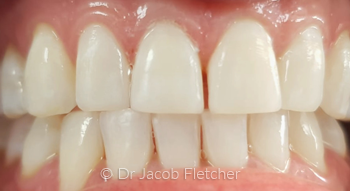Teeth Whitening & Composite Bonding After