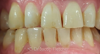 Teeth Whitening & Composite Bonding Before