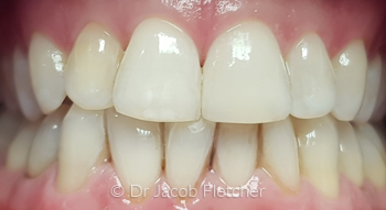 Teeth Whitening & Composite Bonding After