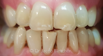 Teeth Whitening & Composite Bonding Before